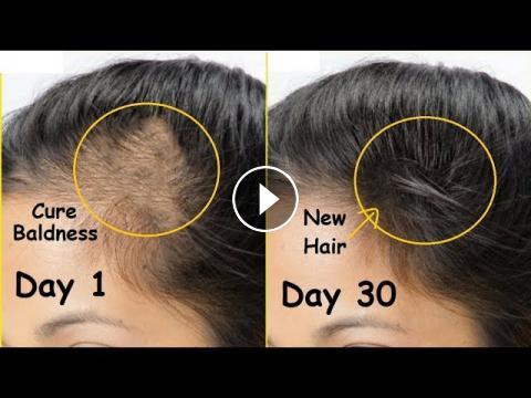 Regrow New HAIR in 30 Days & Cure Baldness | Onion Juice & Garlic for Thick  Hair Growth | Thin Hair